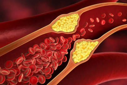 Какие признаки говорят о повышенном холестерине — терапевт 