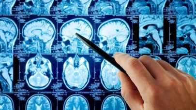 COVID-19 поражает мозг сильнее болезни Альцгеймера – исследования 