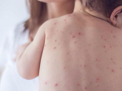 59% детей не получили прививки от кори по решению родителей в РК